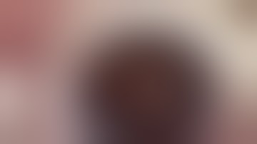 Crystalens Z syndrome repair with CTR/sutured CTS segment by Steven G. Safran MD