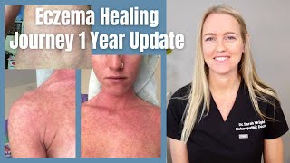 How I Healed My Eczema - One Year UPDATE Eczema Natural Treatment