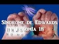 Síndrome de Edwards (Trisomía 18)