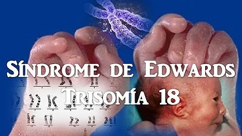 Come riconoscere la sindrome di Down in gravidanza?