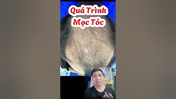 Quá trình mọc tóc sau 3 tháng | Điều Trị Rụng Tóc Hói Đầu | Y Dược TV