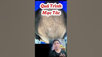 Quá trình mọc tóc sau 3 tháng | Điều Trị Rụng Tóc Hói Đầu | Y Dược TV