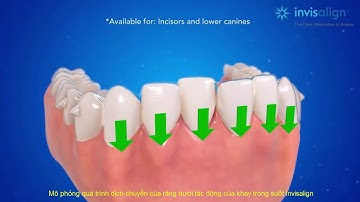 Invisalign Việt Nam - Mô phỏng quá trình dịch chuyển của răng dưới tác động của khay Invisalign
