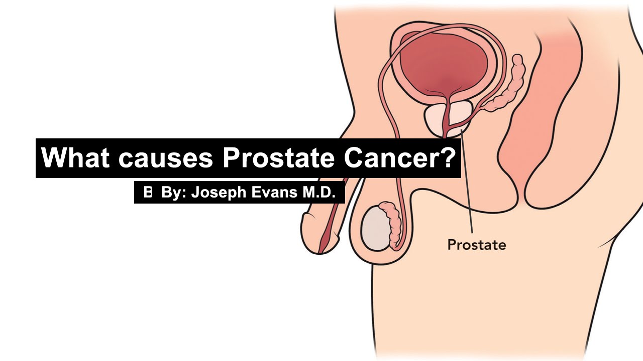 theoretical-causes-of-prostate-cancer-orgasm-granny-and-teen-fuck-the-handyman