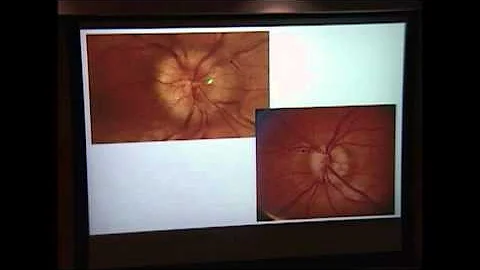 Optic Disc Drusen