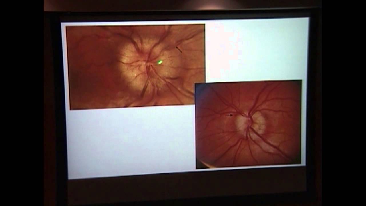http://clinicaltrials.gov Optic Disc Drusen