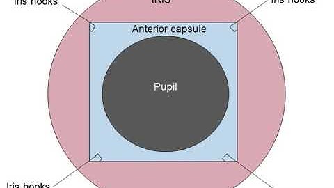 Sulcus IOL implantation for dummies