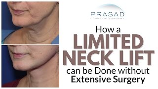 Why Best Neck Lift Results Require Surgery, but a Limited Lift can be Done Without Extensive Surgery