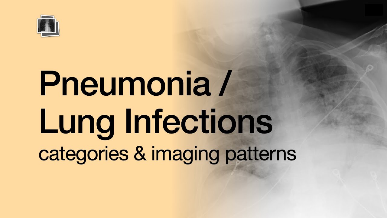Pneumonia / Lung Infections