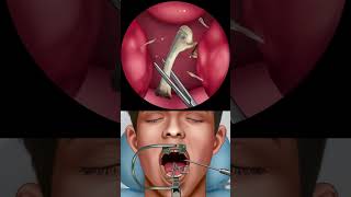 Asmr Getting A Bone Stuck In My Throat