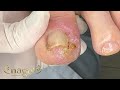 😮 UM SENHORZINHO COM ESTE PROBLEMÃO TADINHO #satisfying #nails