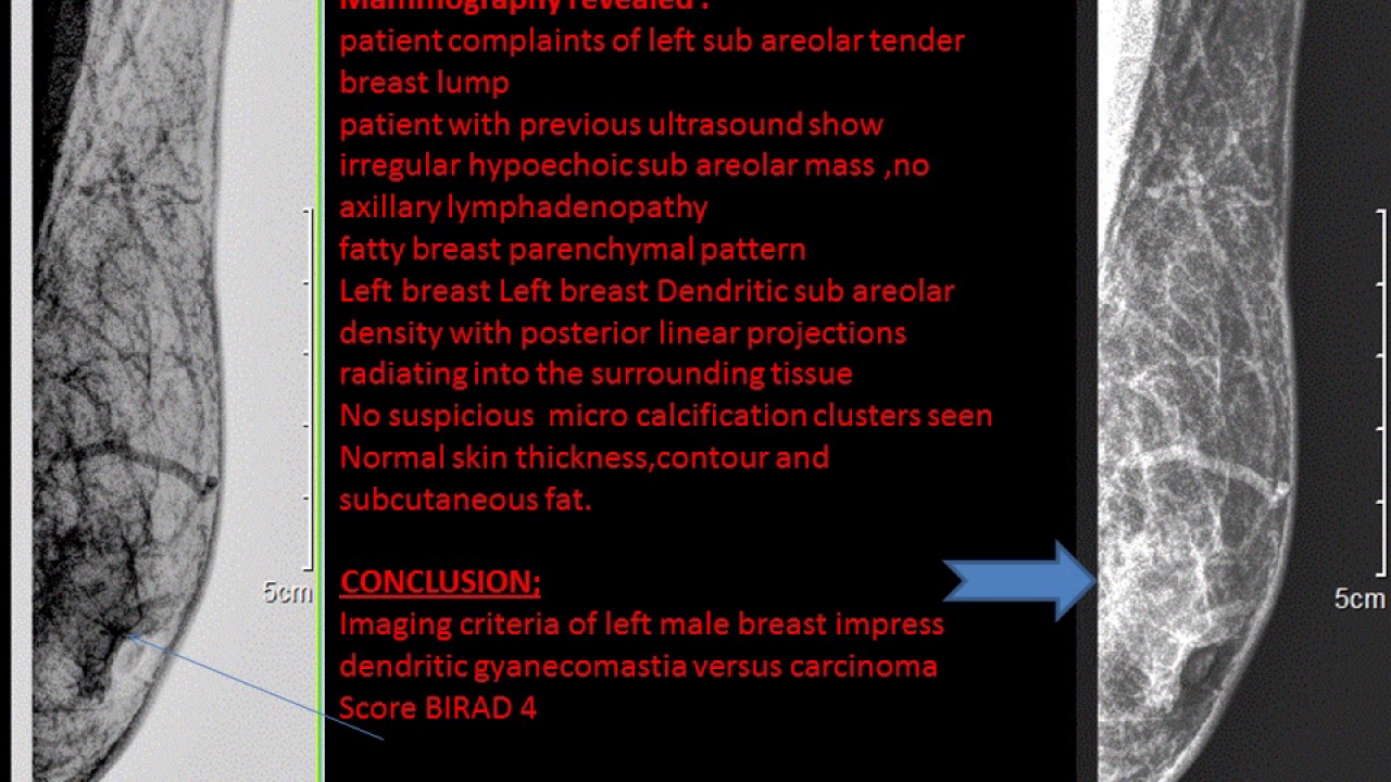 CASE 234 MALE BREAST  MAMMOGRAPHY