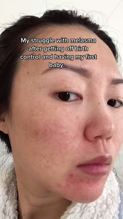 My struggle with melasma