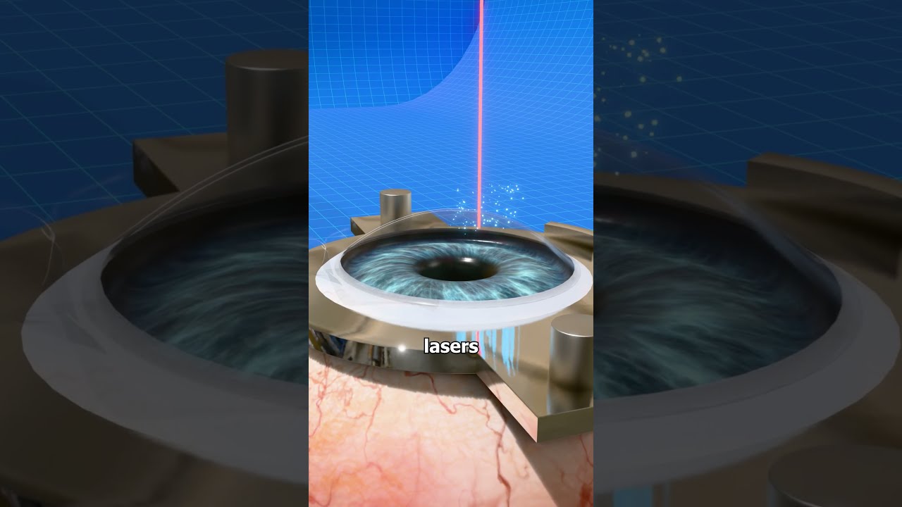 How Laser Eye Surgery Actually Works 