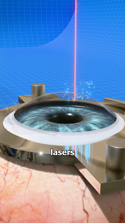 How Laser Eye Surgery Actually Works! 👁️‍🗨️