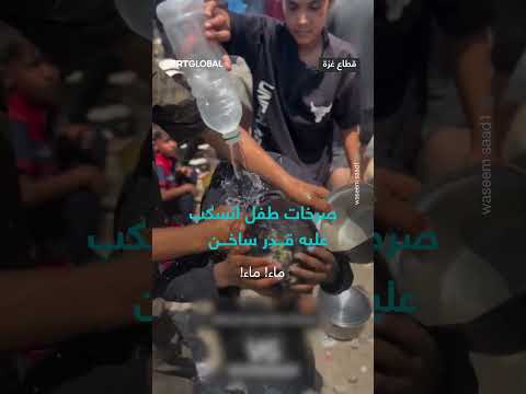 طفل يتعرض لحادث انسكاب قدر ساخن