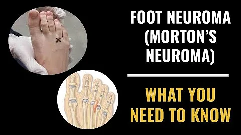 Foot Neuroma (Morton's Neuroma) - What you need to know