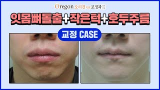 잇몸뼈돌출 + 작은턱 + 호두주름 교정 CASE를 소개합니다! 【Feat. 치아교정전문의 김옥경원장님】