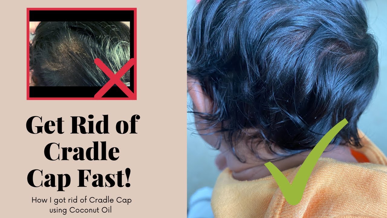 How to get rid of Cradle Cap using Coconut Oil! cradlecap newborn growhairfast babyhair 