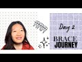 Braces Day 2😬 | Pain, Struggles &amp; What I Ate 🍜| AKKU NISSO🌷