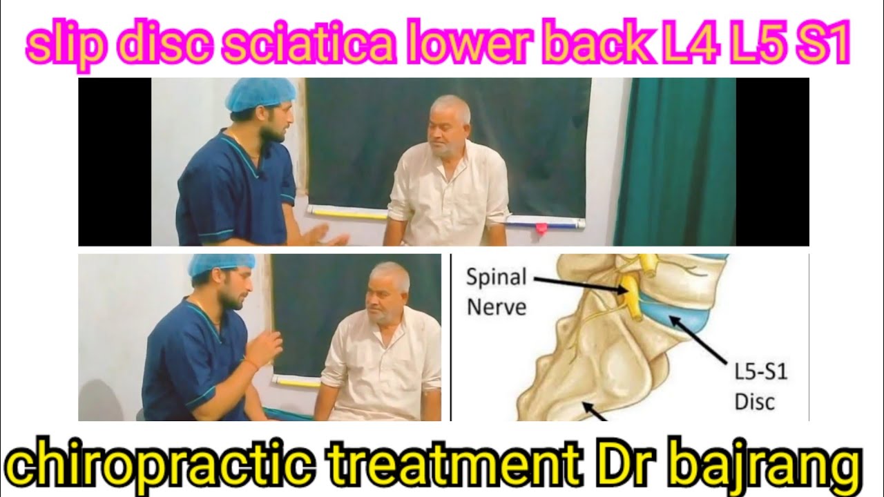 Slip disc L4 L5 S1 Chiropractic treatment Dr bajrang 9719894610 YouTube