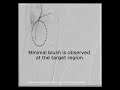 The TAME Lab: Lateral Superior Genicular Artery and Median Genicular Artery