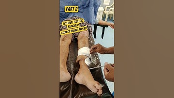 Part 2 | External Fixator Removed! Ilizarov Frame Applied | Real Ortho Case