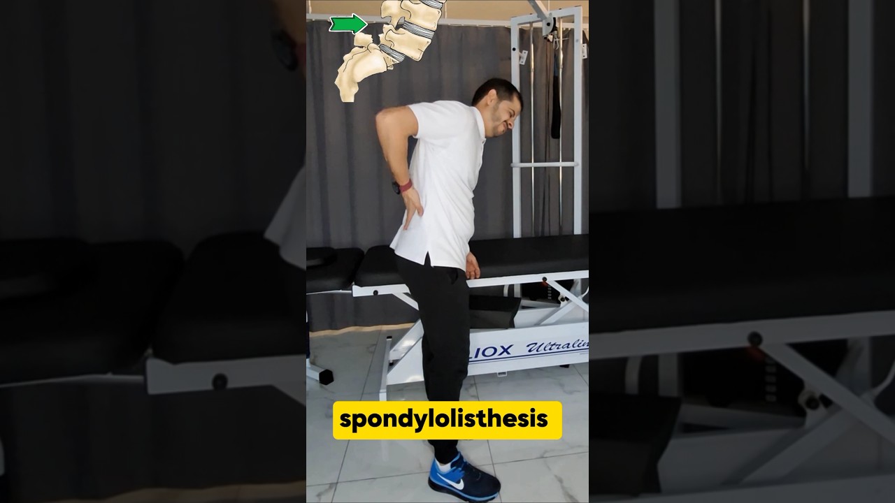 6 exercises to correct spondylolisthesis 