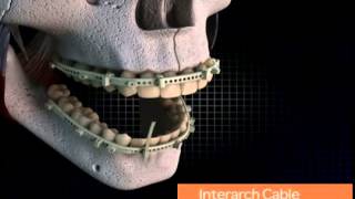 Polymer Intermaxillary Fixation Device
