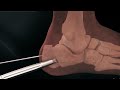 Minimally invasive calcaneus surgery minimally invasive treatment of calcaneal fractureaovivo3d