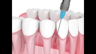 Proof Covid Mrna Nanobot Technology Is Also In Dental Anesthetics And Is In Fact A Bioweapon Of Mass