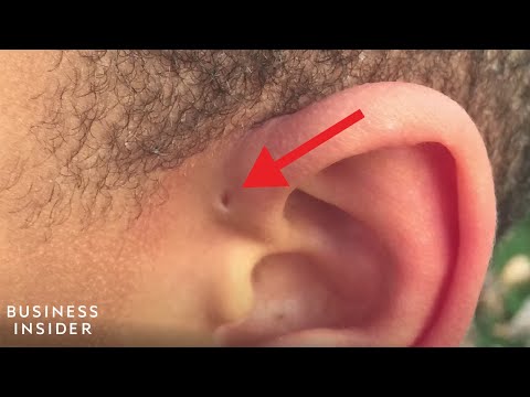 Explaining A Preauricular Sinus,  A Tiny Hole Above Some People&rsquo;s Ears