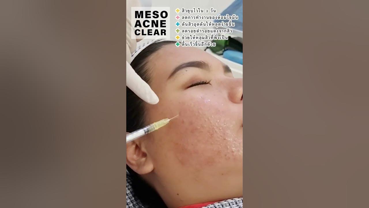 Meso acne clear สะกิดเมโสใต้ผิว สิวยุบไว .. รักษาสิว ที่ แอล คลินิก