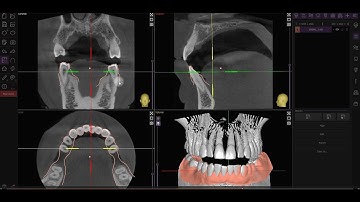 Cheking the STL Alignment