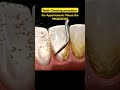 Teeth Cleaning Procedure #teethcleaning #teethwhitening