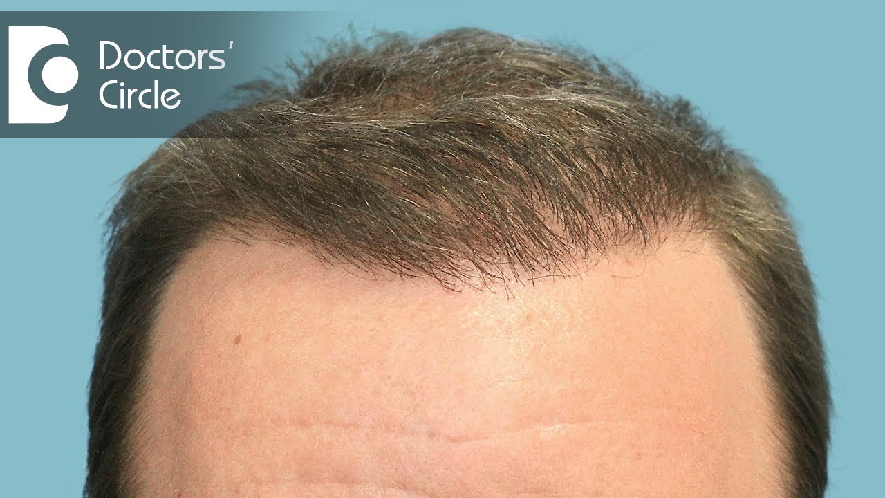 Can You Wear a Hat After Hair Transplant  Best Hair Transplant
