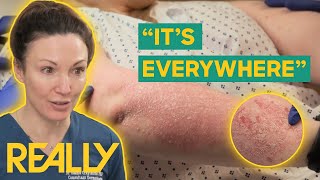 Dr. Emma Helps 21-Year-Old With Painful Psoriasis The Bad Skin Clinic