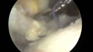 Shoulder Arthroscopy Dr. Cascio: Subscapularis tendon repair in a massive rotator cuff tear