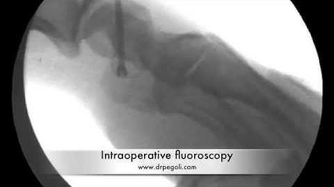 Percutaneous Scaphoid Fixation