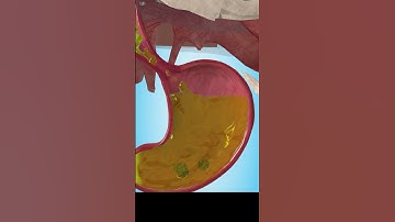 Do I Have GERD? Find out Reason for Acidity in 3D animation