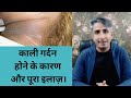 काली गर्दन होने के कारण और पूरा इलाज़। HOW TO REMOVE DARKNESS AROUND NECK I DR. MANOJ DAS