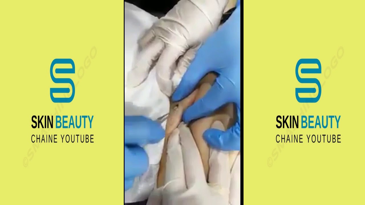 BIGGEST BLACKHEAD REMOVAL EVER IN BACK YouTube