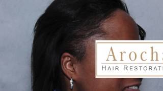 African American Female Traction Alopecia Hair Transplant Dr. Arocha Houston  TX - YouTube