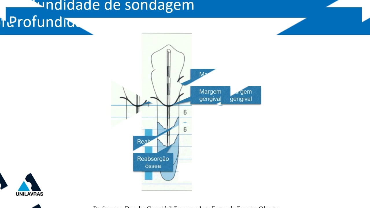 Exame clínico periodontal: sondagem, profundidade de sondagem e nível clínico de inserção