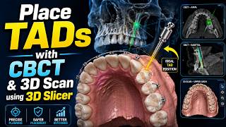 How to Add TADs to CBCT and Digital Dental Scans in 3D Slicer | Orthodontic TAD Planning
