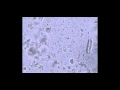 trichomoniasis　トリコモナス症