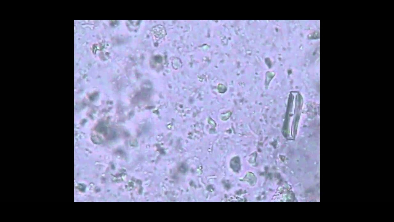 trichomoniasis トリコモナス症 - YouTube