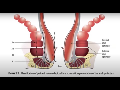 Vídeo: Un Procedimiento Anatómico Para Salvar El Esfínter Anal Para Los Cánceres Rectales Ubicados En La Unión Anorrectal