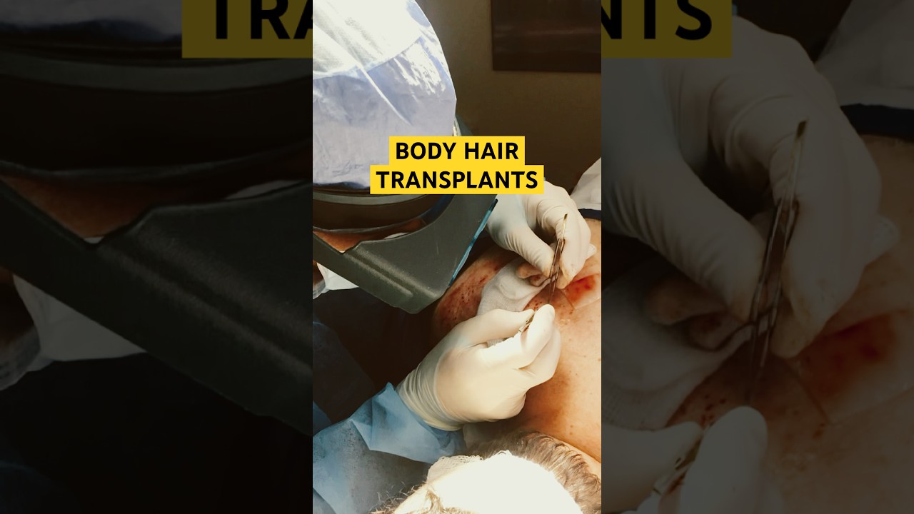 Body Hair Transplants Explained!