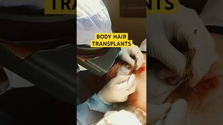 Body Hair Transplants Explained!